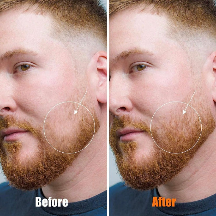 Beard Derma Roller for Beard Growth , 0.25mm